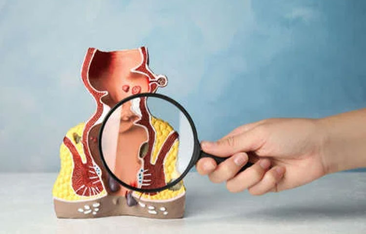 Laser Fissure Fistula Surgery