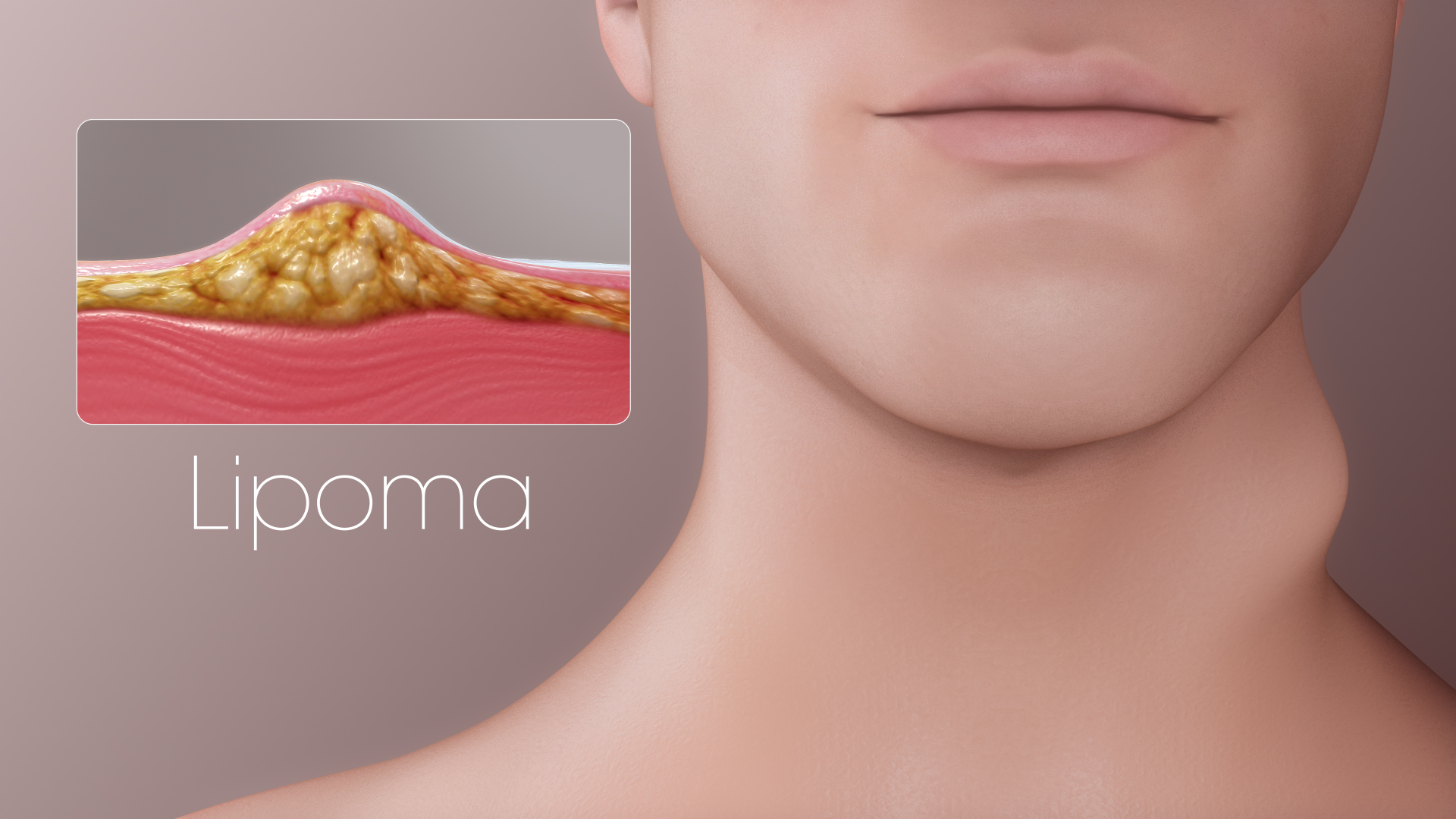 Lipoma Surgery