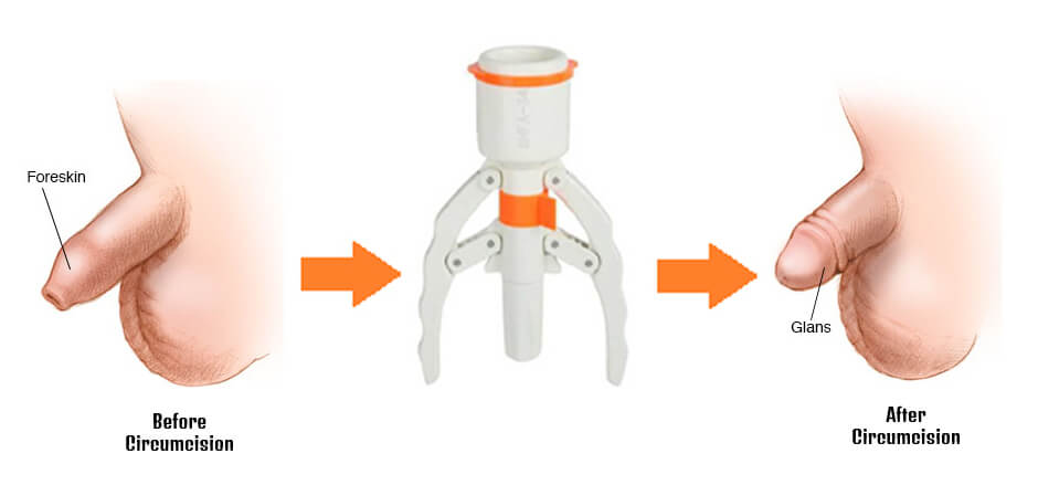 ZSR Stapler Circumcision Surgery